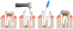 600px-Root_Canal_Illustration_Molar.svg